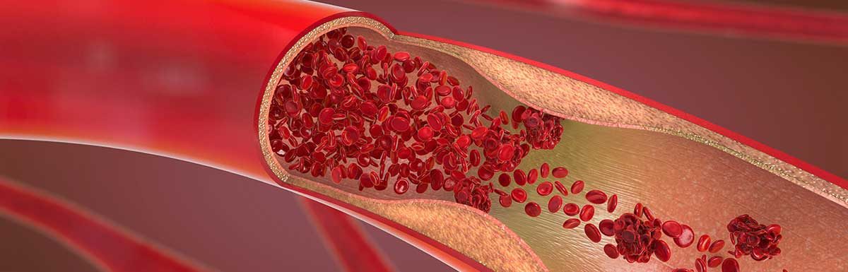 Die Darstellung einer verengten Blutbahn mmit Blutkörperchen im Querschnitt - die diabetische Angiopathie ist eine Gefäßerkrankung.