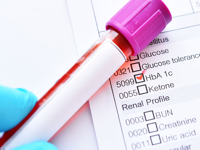 Um regelmäßig den HbA1c zu berechnen, sollten Diabetespatienten alle drei Monate eine Blutprobe abgeben.