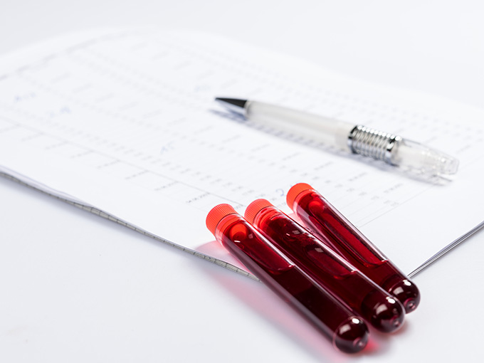 Blutproben auf einem Tisch: Jeder sechste Diabetiker hat einen zu hohen Hba1c-Wert.