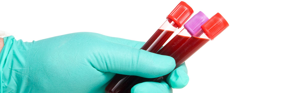 Eine pathologische Glukosetoleranz lässt sich mithilfe einer Blutprobe bestimmen.
