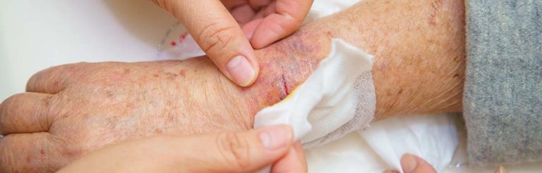 Wundheilung Bei Diabetes Typ 2
